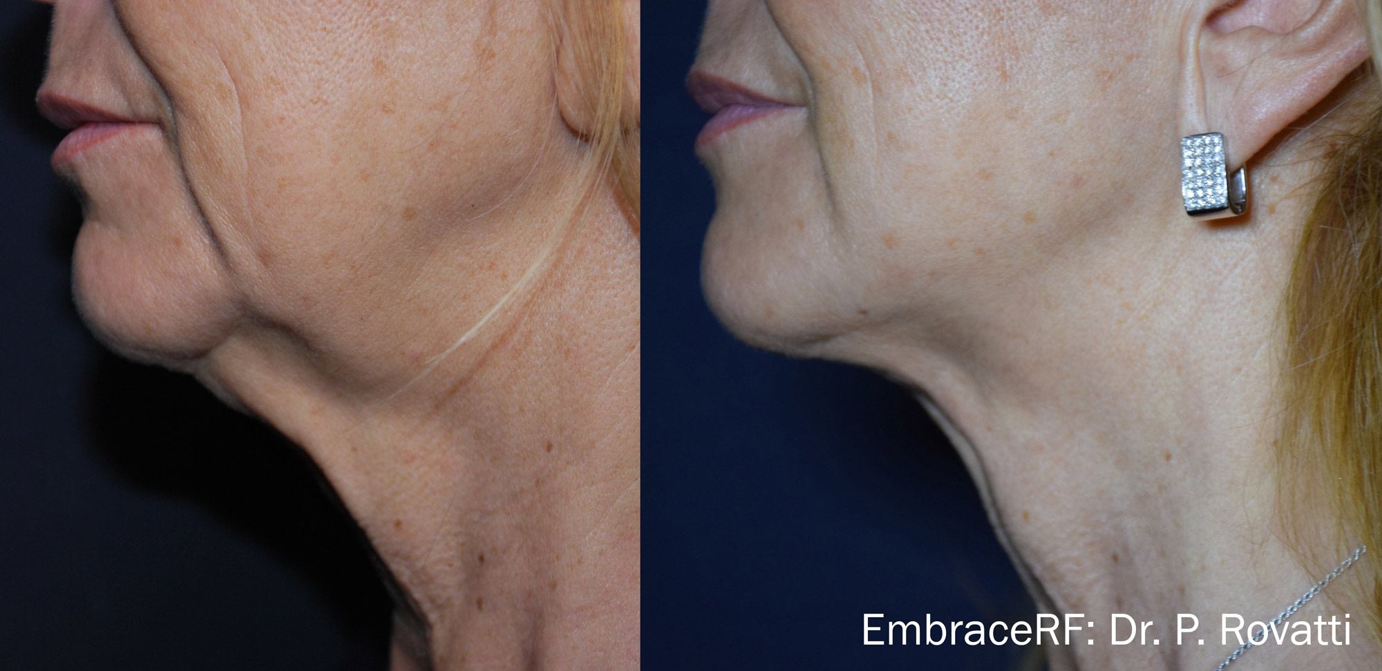 before and after embrace treatment