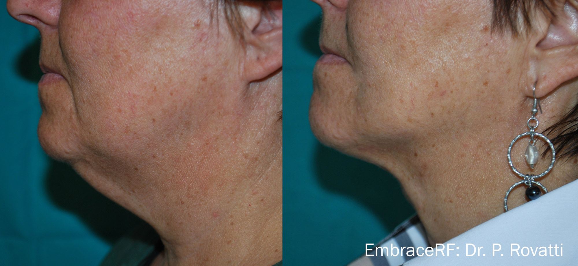 before and after embrace treatment