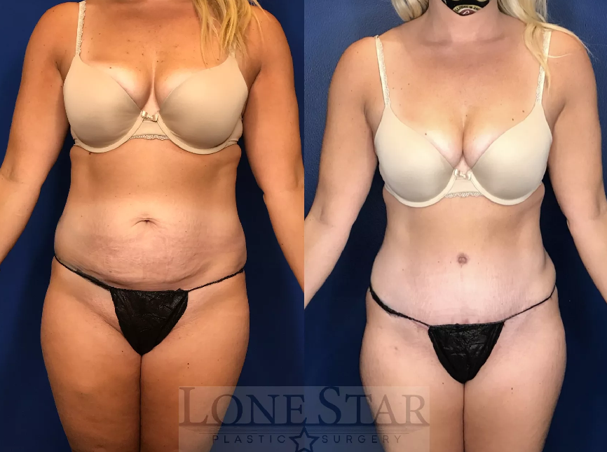 Split image, with the left side showing the before image of a tummy tuck and the right image showing the after results from a tummy tuck, showing a smoother, more contoured stomach.