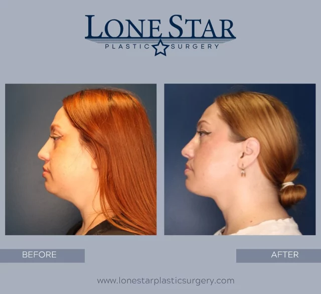 ✨Jawline goals: unlocked.✨⁣
This beautiful patient wanted a more sculpted profile and said goodbye to her double chin with FaceTite + chin liposuction by Dr. Hill. The result? A snatched, natural-looking contour that enhances her entire look.⁣
⁣
Ready to define your jawline? Book your consultation with Dr. Hill and let’s create your before & after. 💉👨‍⚕️⁣
⁣
📍Frisco, TX | @lonestarplasticsurgery

#JawlineContouring #Facetite #ChinLipo #FriscoPlasticSurgery #DoubleChinSolution #BeforeAndAfter #DrSeanHill