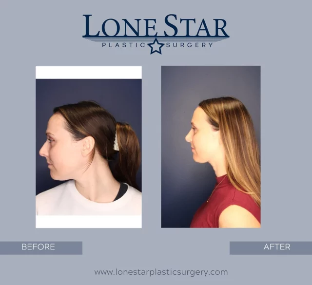 ✨ A confident profile is powerful — and this rhinoplasty transformation says it all.
At just 6 months post-op, this patient already has beautiful refinement of her nasal hump, bulbous tip, and width — with even more subtle definition still to come as swelling continues to settle.
Rhinoplasty requires artistry, precision, and experience — and as a member of The Rhinoplasty Society, Dr. Sean Hill specializes in creating natural, balanced results that enhance your overall facial harmony.
📞 Ready to explore your own transformation?
Book your private rhinoplasty consultation with Dr. Hill at Lone Star Plastic Surgery in Frisco, TX.
📲 Call (214) 937-4879 or visit lonestarplasticsurgery.com to schedule.
#Rhinoplasty #DallasRhinoplasty #FriscoPlasticSurgery #NoseJob #ProfileGoals #RhinoplastySociety #DrSeanHill #LoneStarPlasticSurgery #NaturalResults #FacialBalance #PlasticSurgeonTexas