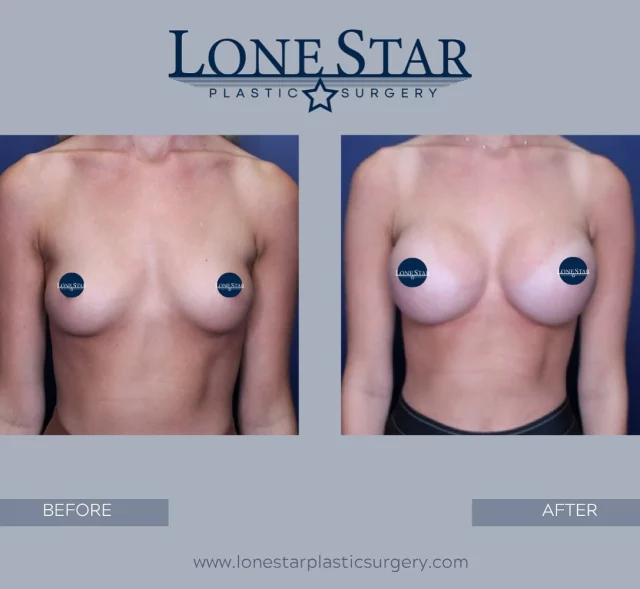 Fuller, feminine, and beautifully balanced 💕
This patient’s before-and-after shows the stunning results of 450cc Allergan full profile implants placed by Dr. Hill for a natural yet enhanced shape.
Ready for your own transformation? Schedule your consult today!
#LoneStarPlasticSurgery #DrSeanHill #BreastAugmentationFrisco #ConfidenceGoals #breastaugmentation #gogummy