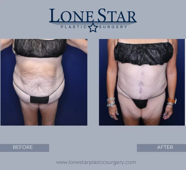 1 year post-op ✨
This patient lost nearly 100 pounds and underwent a fleur-de-lis lower body lift to remove excess skin and restore her shape. Her transformation is nothing short of inspiring. 💪
Dr. Hill specializes in post-weight loss body contouring — helping patients look as strong as they feel.
📅 Schedule your consultation with Dr. Hill today.
#LoneStarPlasticSurgery #BodyLift #WeightLossJourney #DrSeanHill #FriscoPlasticSurgeon #BodyContouring