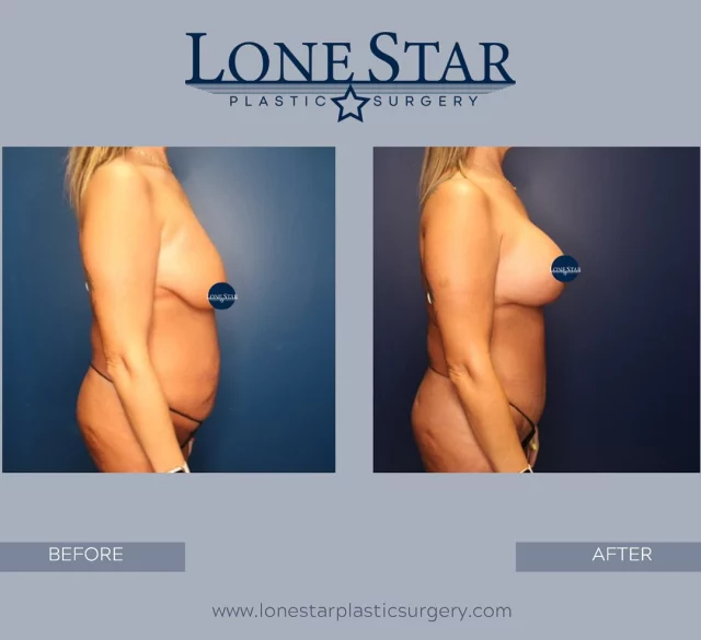 She did the work, and now she gets the reward. ✨
After losing weight and having two children, she chose a mommy makeover with Dr. Hill: tummy tuck, Lipo 360, and a breast lift with implant. Her results speak for themselves.
Your confidence is worth it. Schedule your consult with Dr. Hill.
#TransformationJourney #MommyMakeover #BreastLift #TummyTuck #LoneStarPlasticSurgery