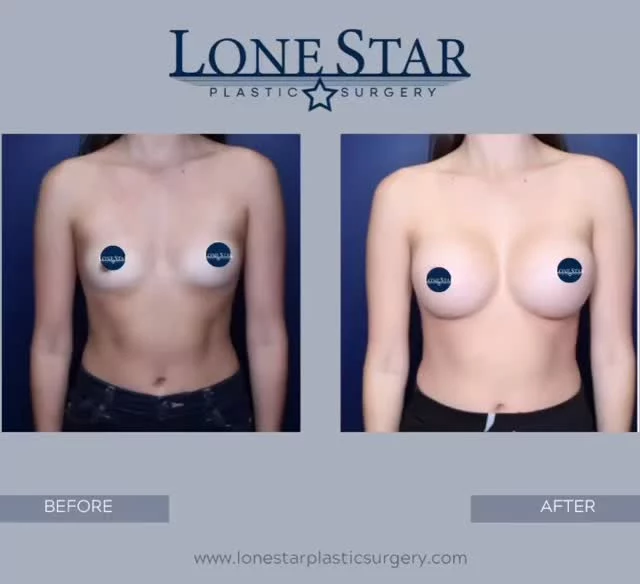 New year, new you… or new boobs ✨😉
These are 3-month post-op results from a rapid recovery breast augmentation — natural shape, beautiful fullness, and confidence in full swing.
Ready to start your own glow-up? Book your consultation with Dr. Hill today.
#NewYearNewYou #RapidRecoveryBreastAugmentation #BreastAug #DrSeanHill