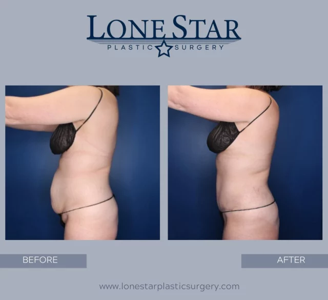 From uncomfortable ➝ confident ✨

This patient was bothered by excess abdominal skin that made her feel uncomfortable in and out of clothing. After a tummy tuck with liposuction, she finally feels confident, sculpted, and ready to enjoy life again 🌴✨

Now? She’s packing for spring break in Cabo with confidence she didn’t have before, and that’s what this is all about.

Performed by Sean Hill, whose expertise in tummy tuck surgery focuses on:
✔️ Removing excess skin
✔️ Restoring a smoother, firmer contour
✔️ Creating natural-looking results that fit your body

If loose skin or abdominal changes are holding you back, you don’t have to live with it.

📍 Frisco, TX
📲 Now booking tummy tuck surgery consultations
Your confidence could be next.

#TummyTuckResults
#ConfidenceRestored
#CaboReady
#Abdominoplasty
#DrSeanHill