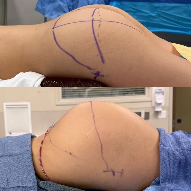 Immediate on-the-table results ✨

This patient had two prior Brazilian Butt Lift attempts using fat transfer—but due to her small frame, she wasn’t able to achieve the projection she wanted. Limited donor fat = limited results.

Enter gluteal augmentation with implants 💪🍑
This approach allowed for:
• Reliable projection
• Improved shape and balance
• Results that fat transfer alone simply couldn’t deliver for her body type

Performed by Sean Hill, with careful attention to proportion, symmetry, and long-term outcomes.

Sometimes the right solution isn’t more fat—it’s the right technique.

📍 Frisco, TX
📲 Now booking surgical consultations
If you’ve been told “you’re too small for a BBL,” you still have options.