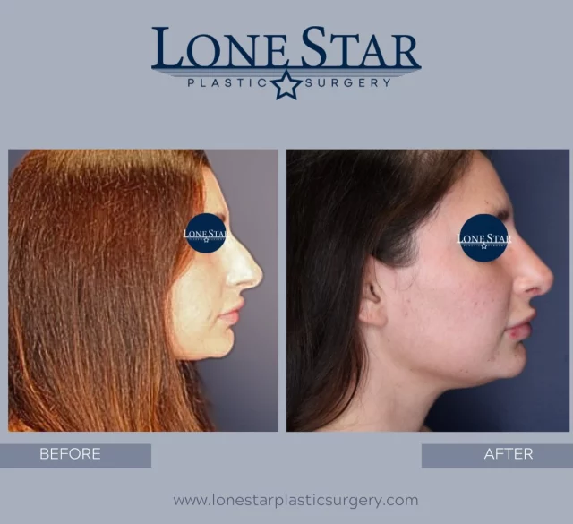 This is more than a before & after 🤍
It’s confidence. Relief. Finally feeling at home in your own face.

For so many patients, rhinoplasty isn’t about changing who they are—it’s about refining, balancing, and letting their true features shine without distraction. The emotions that come with seeing themselves in the mirror for the first time afterward? That’s the part we never take lightly.

Performed by Sean Hill, a proud member of The Rhinoplasty Society, where advanced training, precision, and respect for nasal function and facial harmony are paramount.

If you’ve been living with insecurity every time you see your profile…
If you’ve been waiting years to finally feel confident…
This could be your moment.

📍 Frisco, TX
📲 Now booking rhinoplasty surgery consultations
Your face. Your confidence. Your time.

#RhinoplastyBeforeAndAfter
#RhinoplastySurgeon
#NoseJobResults
#RhinoplastyExpert
#FacialPlasticSurgery