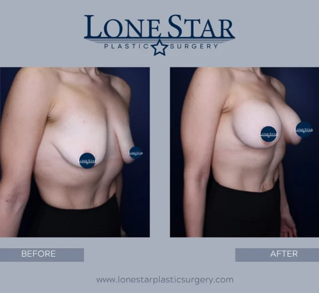 Weight loss can change the shape and fullness of the breasts — and sometimes restoring volume is all that’s needed to feel confident again.

This patient wanted a natural, fuller look after weight loss and achieved her goals with breast augmentation alone. Thoughtful implant selection can restore upper pole fullness, improve shape, and create beautiful balance while still fitting your body naturally.

Considering breast augmentation after weight loss? Schedule a consultation with Dr. Sean Hill to discuss the best options for your goals.

#BreastAugmentation #BreastAugmentationAfterWeightLoss #NaturalBreastAugmentation #PlasticSurgery #BoardCertifiedPlasticSurgeon BeforeAndAfter MommyMakeover WeightLossTransformation FriscoTX LoneStarPlasticSurgery