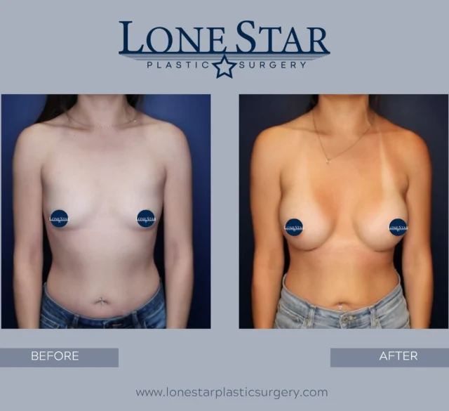 ✨ The best compliment after a breast augmentation? “Did she or didn’t she?” ✨

This patient wanted an enhancement that would keep them guessing—more fullness, better shape, and improved balance while still looking like her natural self.

Using a 335cc full-profile implant, we created a result that complements her frame without overwhelming it. Beautiful, proportional, and confidence-boosting.

Every breast augmentation is customized to the patient’s anatomy and goals. The right implant isn’t about a specific size—it’s about creating the look that’s right for you.

Ready to explore your options? Schedule your consultation with Dr. Hill to learn what’s possible.

📍 Frisco, TX

#BreastAugmentation #BreastImplants #NaturalBreastAugmentation #BoobJob #PlasticSurgery FriscoTX DallasPlasticSurgeon DrSeanHill
