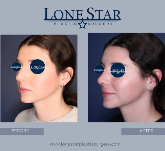 Sometimes the best results are worth the wait. ✨

This patient first came to see us over 4 years ago, but the timing wasn’t right for surgery. When she was finally ready, we created a rhinoplasty plan focused on what mattered most to her: a smoother profile without a dorsal hump, a narrower appearance from the front, and a refined nasal tip.

Now, just 3 months after surgery, her results are already taking shape beautifully. While swelling will continue to improve over the next several months, the enhanced facial balance and natural refinement are already evident.

If you’ve been thinking about rhinoplasty but haven’t felt ready, that’s okay. The right time is when you are ready—and sometimes the results truly are worth the wait.

📍 Frisco, TX
📞 Schedule your consultation with Dr. Hill today.

#Rhinoplasty #RhinoplastyResults #NoseJob #DallasRhinoplasty #FriscoPlasticSurgeon FacialHarmony ProfileRefinement NaturalResults