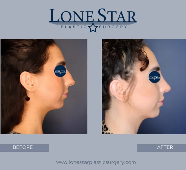 ✨ 6 months after rhinoplasty ✨

This patient wanted a nose that felt more balanced with her facial features—a smoother profile with reduction of the dorsal hump, a more refined tip, and a narrower appearance from the front.

At just 6 months, her results are already looking beautiful, and subtle improvements will continue as swelling resolves over the coming months.

Rhinoplasty is one of the most complex procedures in plastic surgery and requires both technical precision and an artistic eye. Dr. Hill has extensive experience performing primary, revision, and functional rhinoplasty, helping patients achieve natural-looking results that enhance—not change—their unique features.

Considering rhinoplasty? Schedule a consultation to discuss your goals and learn what may be possible for you.

📞 Call our office or visit the link in our bio to book your consultation.

#Rhinoplasty #NoseJob #DallasRhinoplasty #FriscoPlasticSurgeon #RhinoplastyResults