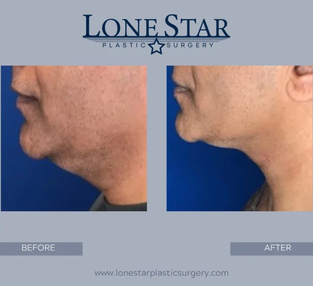 Happy Father’s Day to all the dads out there! 👔

This patient wanted a stronger, more defined jawline and a reduction in fullness beneath the chin. Using liposuction combined with FaceTite, we were able to create what we like to call the Executive Jawline—a sharper profile with improved definition and contour.

A well-defined jawline can make a big difference in how you look and feel, helping you appear more refreshed, confident, and youthful without looking overdone.

Men are one of the fastest-growing groups seeking facial contouring procedures, and Dr. Hill customizes each treatment to maintain a natural, masculine appearance.

Thinking about improving your profile? Schedule a consultation with Dr. Hill to learn if the Executive Jawline procedure is right for you.

📞 Call our office or click the link in our bio to book your consultation.

#FathersDay #ExecutiveJawline #FaceTite #ChinLiposuction #MensAesthetics JawlineContour ProfileGoals DrHill LoneStarPlasticSurgery