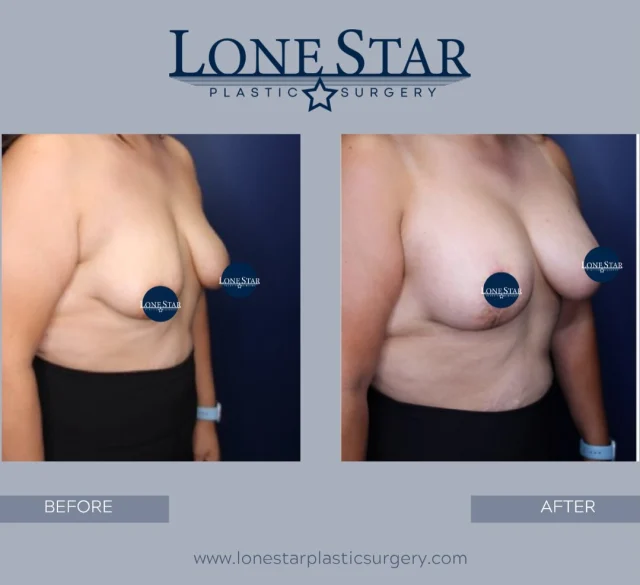 Weight loss can be life-changing—but it can also leave behind changes that diet and exercise can’t restore.

This patient came to us after significant weight loss with concerns about breast deflation and loss of upper pole fullness. Her goal was to regain shape, restore volume, and achieve a more youthful breast contour while maintaining natural proportions.

To accomplish this, she underwent a breast lift combined with a 345cc moderate-profile silicone implant. At just 3 months after surgery, her results already show improved fullness, enhanced shape, and a more balanced silhouette.

Every breast procedure is customized to the patient’s anatomy, lifestyle, and goals. The best results don’t look “done”—they look like the way you were meant to feel.

Ready to learn your options after weight loss? Schedule a consultation with Dr. Hill.

📍 Frisco, TX

#BreastLift #BreastAugmentation #WeightLossTransformation #BreastImplants #SiliconeImplants