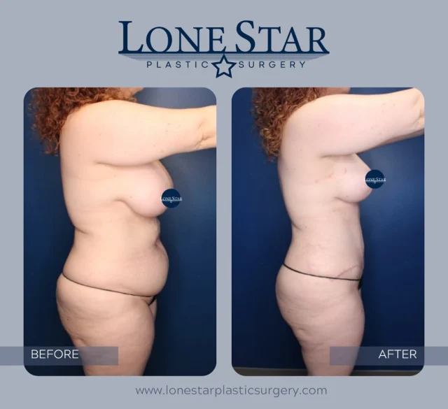 Motherhood changes so much—and while many of those changes are worth celebrating, it’s also okay to miss the way you once felt in your own skin. 🤍

This beautiful patient chose a Mommy Makeover to restore what pregnancy and breastfeeding had changed. Her personalized procedure included a breast lift with implants, a tummy tuck with liposuction, helping her regain her shape while staying true to her natural proportions.

These before-and-after photos aren’t just about a flatter abdomen or fuller breasts. They’re about renewed confidence, feeling comfortable in your clothes again, and recognizing the woman in the mirror.

Every Mommy Makeover is tailored to your unique anatomy and goals because no two journeys are the same.

If you’re ready to invest in yourself after everything you’ve given to your family, we’re here to guide you every step of the way.

✨ Schedule your Mommy Makeover consultation with Dr. Hill today.

📍 Frisco, TX

#MommyMakeover #BreastLift #BreastAugmentation #TummyTuck #Liposuction