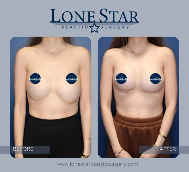 A beautiful result starts with a solid foundation

Not every breast augmentation is a first-time procedure.

This patient came to Dr. Hill after implants placed by another surgeon had bottomed out over time, leading to an unnatural appearance and loss of support. To restore both shape and position, Dr. Hill performed a revision breast augmentation with an implant exchange and an internal bra for added support.

Breast revision surgery is often more complex than a primary breast augmentation and requires careful planning, surgical precision, and an individualized approach. The goal isn’t just to replace implants—it’s to create beautiful, natural-looking results that are built to last.

If you’re unhappy with the results of a previous breast augmentation, you don’t have to settle. We’re here to help you explore your options and create a treatment plan that’s right for you.

📍Schedule your consultation with Dr. Hill to learn if breast revision surgery is right for you.

#DrSeanHill #LoneStarPlasticSurgery #BreastRevision #BreastAugmentationRevision #InternalBra